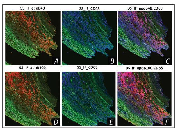 Both hepatic apob100 and intestinal apob48 co-localize with macrophages in human carotid atherosclerotic plaques Objective : To evaluate co-localization of apob48 and apob100 with macrophages.