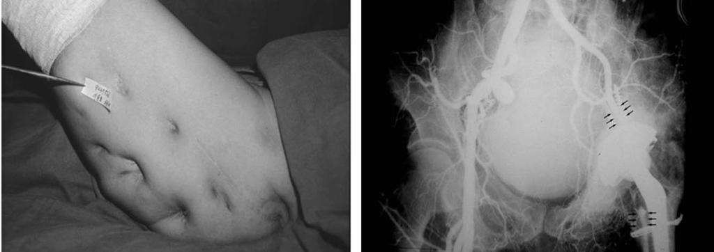 이중명 A B C Fig. 3. (A) Preoperative radiograph and photograph of 50-year old Tbc sequelae patient showed shortening and destruction of proximal famur.