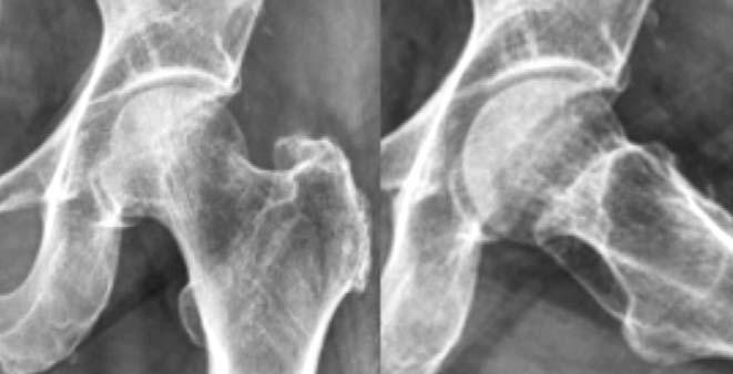 김신윤 Fig. 1. Anteroposterior and frog leg lateral pelvic radiographs shows Steinberg IIC lesion in a 64 year-old female patient. Fig. 2.