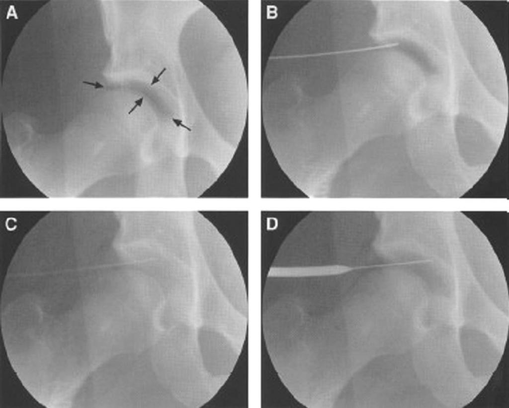 Arthroscopy of the Hip Joint 에있는 Bigelow Y 인대의긴장을풀어주어, 견인수기를원활하게한다. 장축으로의견인이시행되기전에, 잘패딩된외측회음부기둥 (lateral perineal post) 을설치해야하며외전력에잘적응하는지확인해야한다.