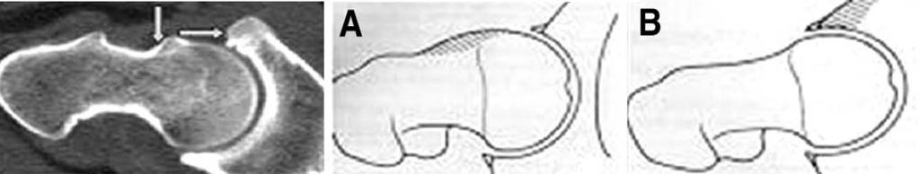 Arthroscopy of the Hip Joint Fig. 16. The Factor causing FAI are shown. (A) cam impingment, (B) pincer impingement.