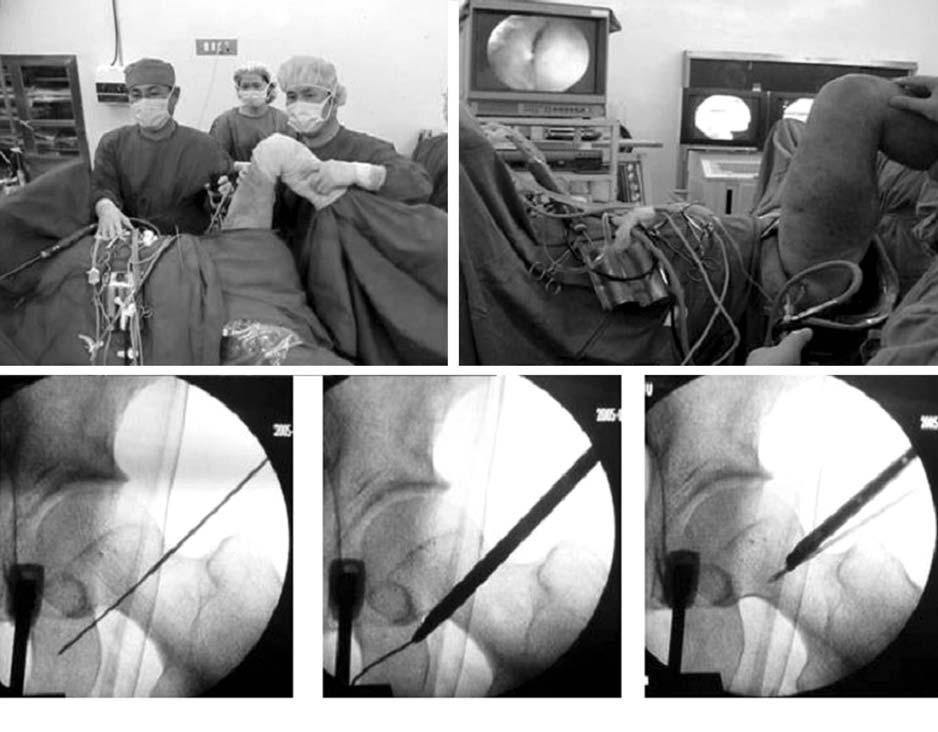 Arthroscopy of the Hip Joint 굴곡이관절내용적을증가시키는데필수적이다. 이는관절내에서관절경을움직일때발생할수있는대퇴골두연골과활막주름에손상을피하는데중요하다. 또한연부조직종창을예방하기위해세척생리식염수의압력은 70 mmhg 이하로유지하는것이중요하다.