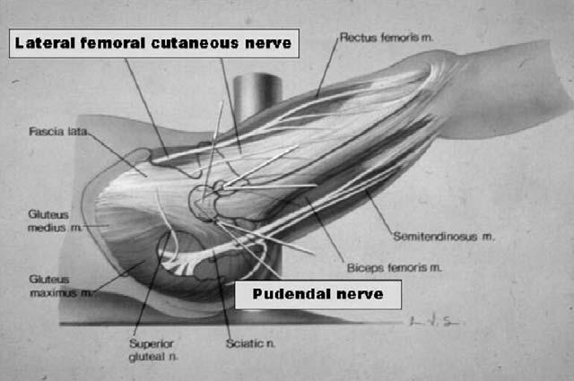황득수 6. 합병증 고관절의관절경후발생할수있는합병증으로외음신경 (external pudendal nerve) 과좌골신경의손상, 외측 대퇴피하신경 (lateral femoral cutaneous nerve), 국소적인화골성근염, 회음부의혈종, 드물게관절세척액의복강내유출에의한급성복통및심정지의예도보고하고있다 2,4,13) (Fig. 25). 7. 결론 Fig.