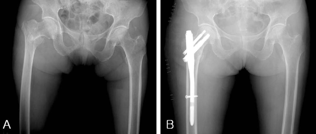고관절골절의최신지견 Fig. 5. 76-year-old male with intertrochanteric fracture. (A) preoperative radiograph of Kyle type II intertrochanteric fracture.