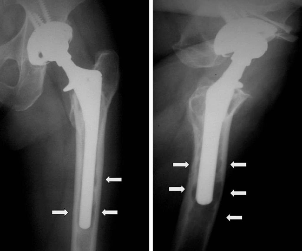 근위부미세포말형대퇴스템 (Proximal Porous Coated Femoral Stem) 하는경우대퇴스템의 stiffness는직경의 4제곱에비례하므로스템의굵기가굵어질수록 stiffness는증가되며골조직과의 stiffness의차이로인해대퇴동통을유발하게된다 5,27).