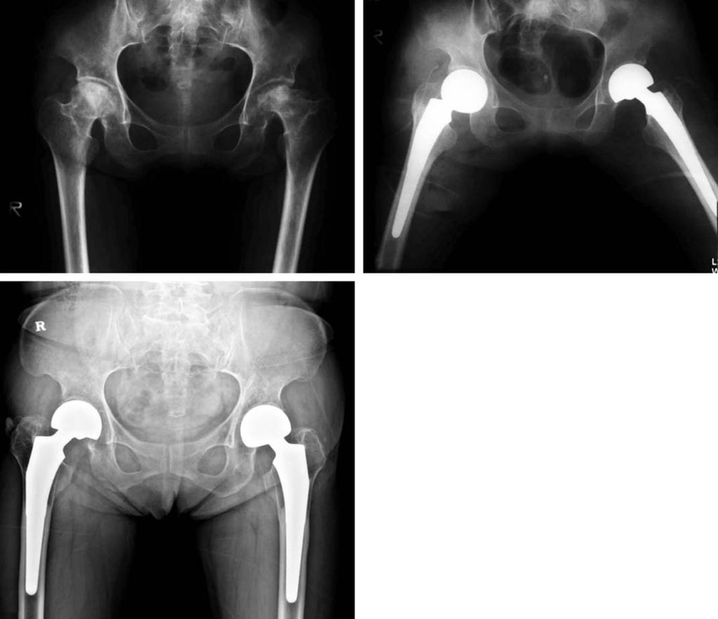 대퇴골두무혈성괴사에서의양극성반치환술 A B Fig. 1. (A) Preoperative radiograph shows bilateral osteonecrosis of the femoral head.