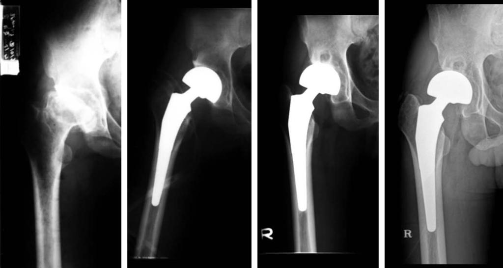 (C) Postoperative 20 years radiograph shows well performing bipolar hemiarthroplasty such as good osseointegration of stem, well preserved acetabular cartilage and no evidence of osteolysis.