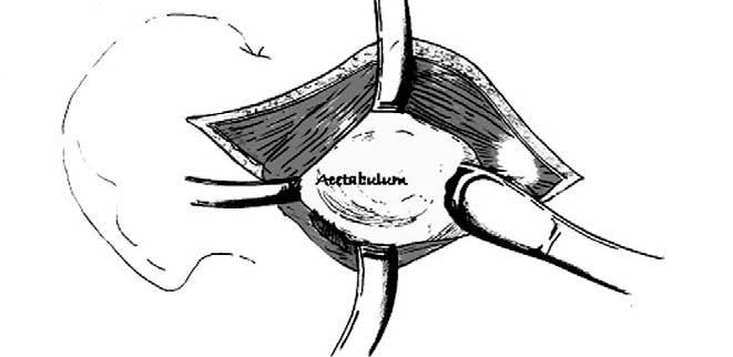 1). 대퇴근막은피부절개선에맞추어절개한후 (Fig. 2), 노출된중둔근 (gluteus medius) 중대전자의앞쪽의약 25% 근육을근육주행방향에따라 L-shape으로절개하고절개된중둔근을대전자부에서 bone wafer와함께떼낸다음 (Fig.