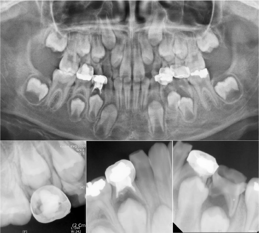 Ji Eun Lim, et al : Dental Treatment of Child with Hemophilia 인 치료를 포함하고 있다. 따라서 치과치료 후에 출혈이 심하 다.