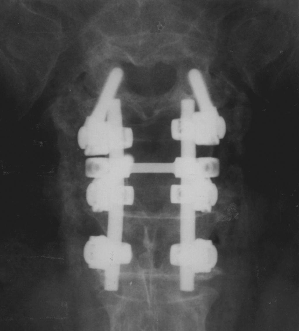 Posterolateral spinal fusion using autograft and OsteoSet pellets was performed with transpedicular