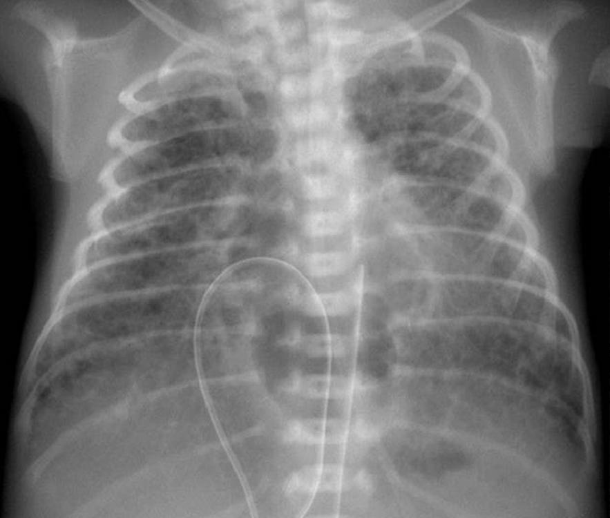 Chest radiograph at 6 days after birth (A) shows left