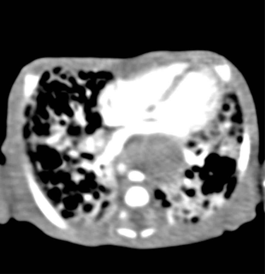 loculated retrocardiac pneumomediastinum surrounding