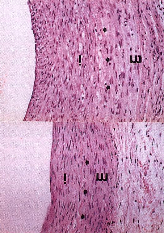 Fig. 2. Microphotographs showing hematoxylin and eosin staining of iliac arteries of normocholesterolemic and hypercholesterolemic rabbits on 14 days after overstretch-injury.