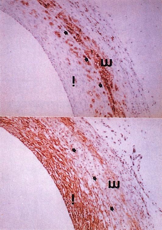 Microphotographs showing proliferating macrophage and smooth muscle cells around macrophage infiltration at day 14 after injury in hypercholesterolemic rabbit, which was doubled-stained with antibody