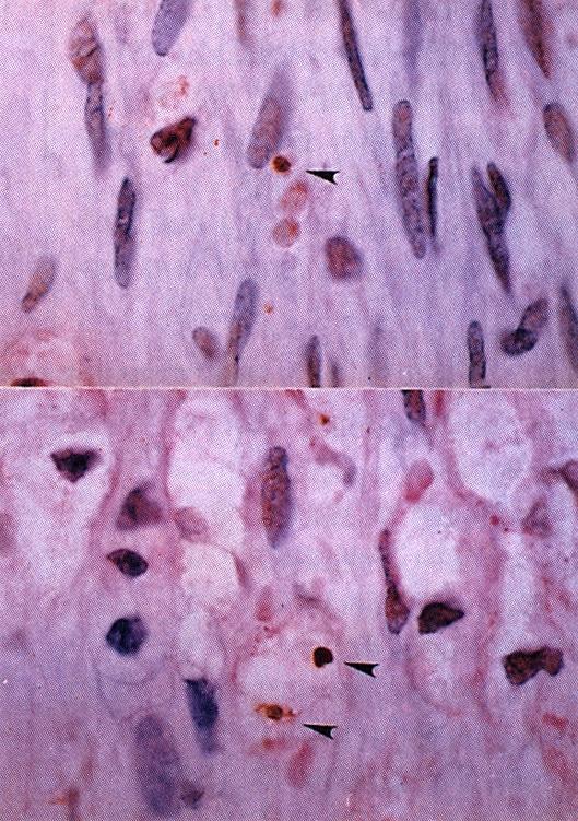 Upper panel Proliferating macrophages shown as brown nucleus and red cytoplasm, were frequently observed around internal elastic lamina.