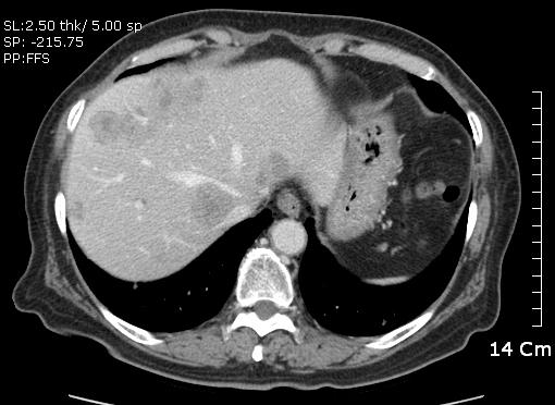 안지혜외사상체질의학회지 2011;23(4):533-540 535 Figure 1. APCT shows multiple liver metastasis (Sep.2011) Figure 2.