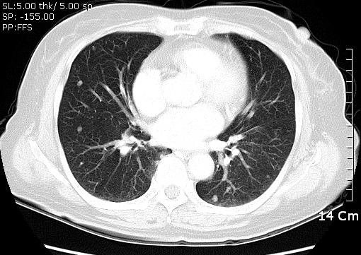 The lateral face Slightly increased size of the metastatic lesion in the liver overall increased tumor burden 2) Chest