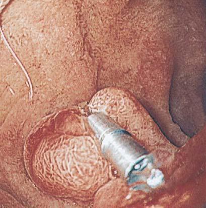 (B) After washing of bleeding site by normal saline, mucosal abnormality and ulceration are not found. Figure 2. Endoscopic findings of duodenum.