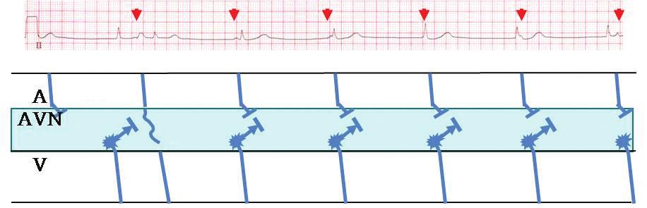 Intermittent sinus capture occurs (arrow) and produces incomplete AV dissociation. Figure 1-B. Interference dissociation between an S-A and A-V nodal rhythm is present.