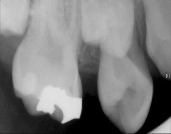 Cahill과 Marks 9) 는치낭을수술적으로제거한치아에서치아가맹출하지않는다는것을밝혔고, 치낭에서파생된치주인대가설치류의절치부와같은연속성있는맹출에서중요역할을한다고하였다 6). 치낭의존재는맹출로의골흡수뿐아니라맹출중인치아의하방부에있는 trabecular bone 형성에도필수이며, 치낭에서파생된치주인대는출은후의치아맹출에관여한다고밝혀졌다 1,6).