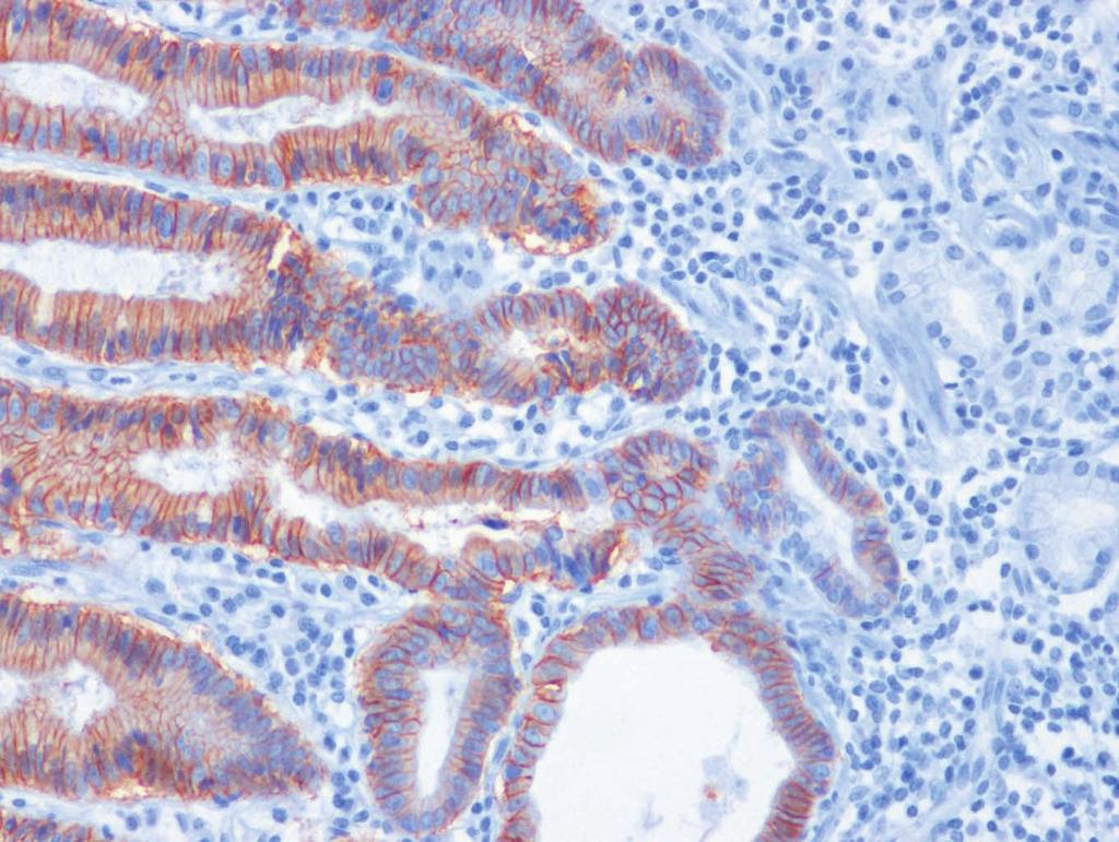 497 HER2 Status in Gastric Adenocarcinomas A B C D E F Fig. 1.