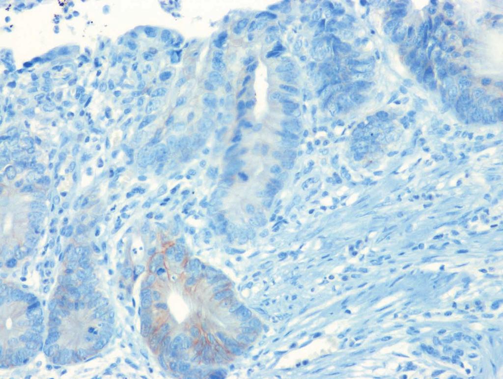 negative (IHC 0/1+) for human epidermal growth factor receptor 2