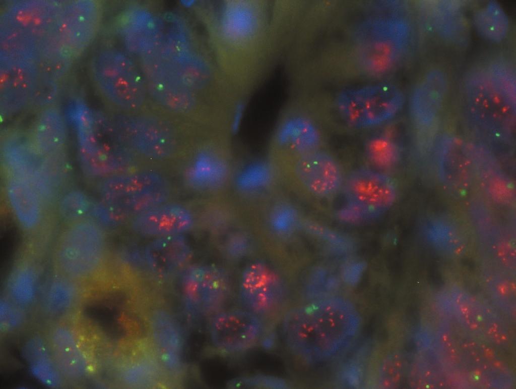 (C) SISH show clusters of HER2 signals in tumor cells.