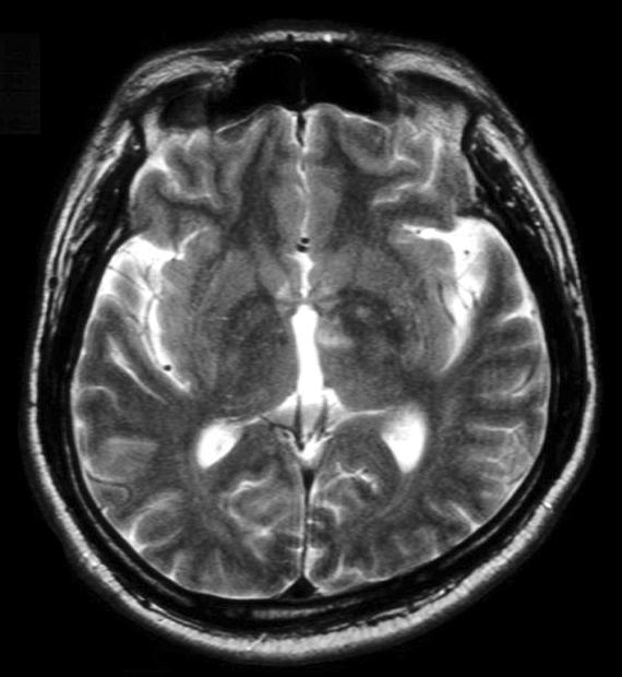 김연희 뇌신경재활 영역에서 치매의 이해와 역할 한 병변은 처음 주로 해마에서 나타나기 시작해서 점차적 아니라 도구적 ADL 장애 및 지남력 장애, 망상, 환시, 초 으로 전 뇌에 퍼지게 된다. 조 등의 이상 행동이 흔하다.