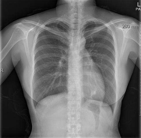 - 최지성외 6 인. M. gordonae 폐질환 - A B Figure 4. Chest X-ray after 2 months (A) and 12 months (B) of anti-mycobacterial treatment for Mycobacterium gordonae pulmonary infection.