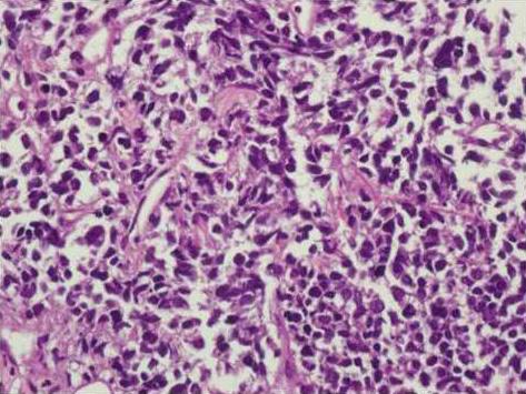 - Hyunjeong Im, et al. A case of three different primary lung cancers - Figure 3.