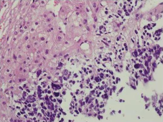 Invasive adenocarcinoma (mixed acinar and solid) at the right upper lobe of the lung, wedge resection (hematoxylin and eosin staining, 400). Figure 4.