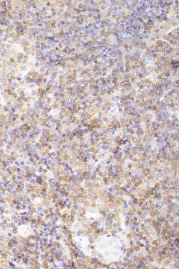 이규엽 외: 피부에 발생한 원발성 변연부 B-세포 림프종 2예 불규칙한 모양의 핵과 옅고 풍부한 세포질을 가진 여포세 포(centrocyte)나 여포아세포(centroblast)와 유사한 형태의 세포,