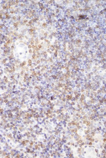 3 mm 펀치 생검 결과, H&E 염색상 저배율에서 진피에서 반응성 림프 여포(reactive lymphoid follicle)를 형성하는 듯한 구조를 보이는 세포 침윤이 관찰되었고(Fig.