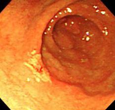 (C, D) One year later, a large excavating ulceration was observed at the angle and another active ulcer was seen at the antrum.