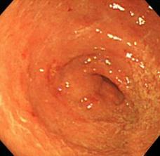 (I, J) Follow-up gastroscopic findings after 9 months showed diffuse infiltrative-type AGC with hypertrophied mucosa at the lesser