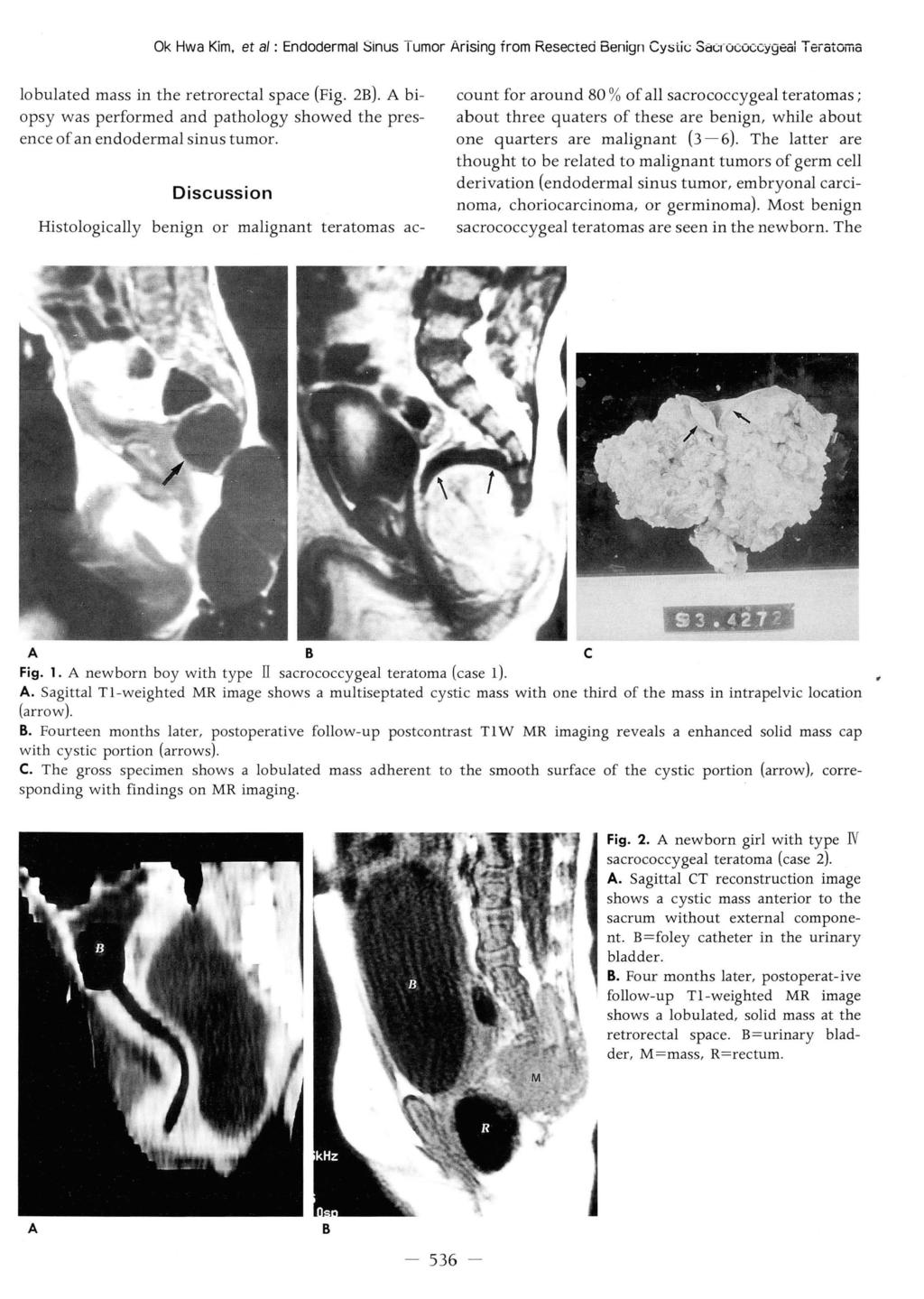 되Ok Hwa Kim. et af : Endodermal Sinus Tumor Arising from Resected Benign Cy:;liι Sac(ûι ιcyge 허 Te atg 페 a lobulated mass in the retrorectal space (Fig. 2B).