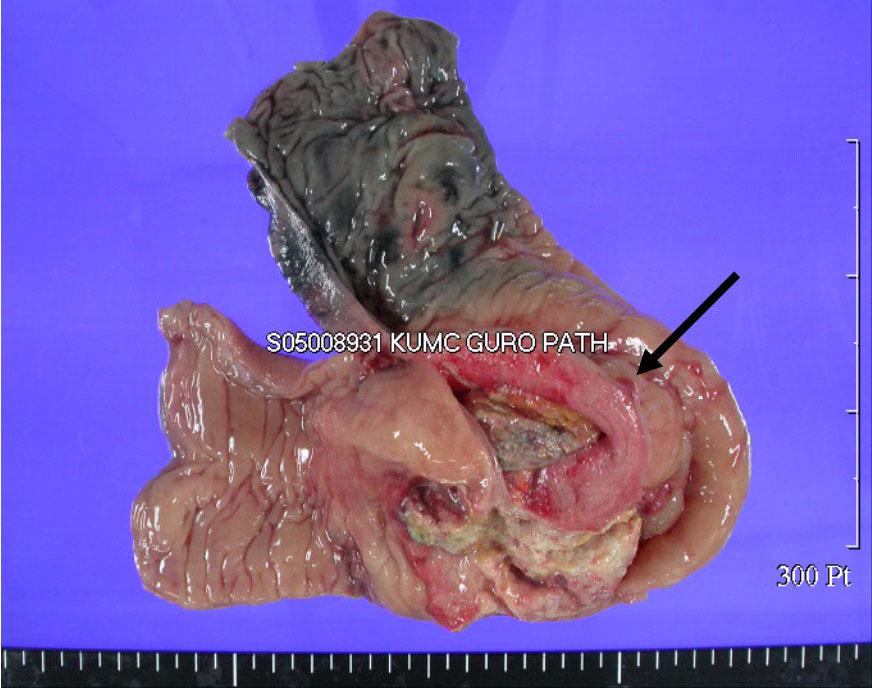 대한내분비학회지 : 제 21 권제 5 호 2006 A B Fig. 3. Post-operation gross finding. A, Gross section finding of a Lt. colon cancer. The mucosal surface shows an ulcerofungating mass (dark arrow), measuring 10.
