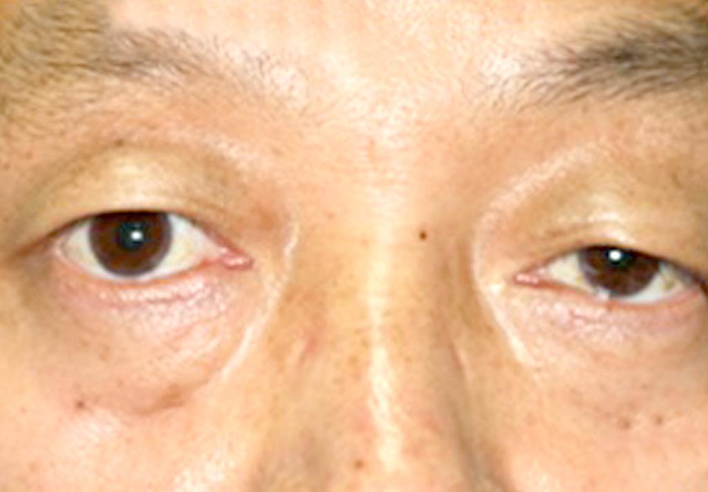 Down and lateral gaze limitation of right eye is prominent (A, B).