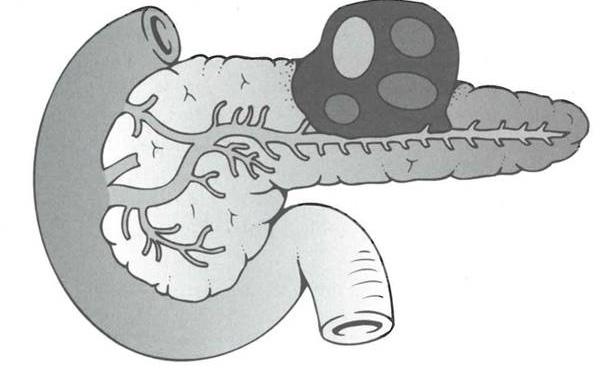 Cartoon of mucinous cyst neoplasm of pancreas.