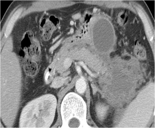 CT scan of pancreatic pseudocyst.