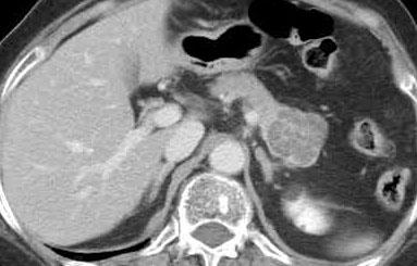 CT scan of serous cystadenoma. There is microcystic cystic mass with central stellate septa at body of pancreas.