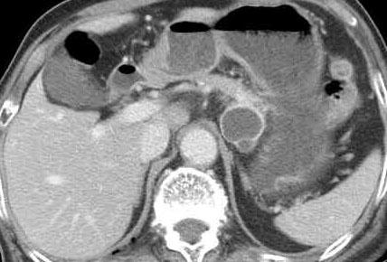 There is medium-sized cystic mass with thick wall and eccentric septum at tail of pancreas. Figure 11. CT scan of intraductal papillary mucinous neoplasm.