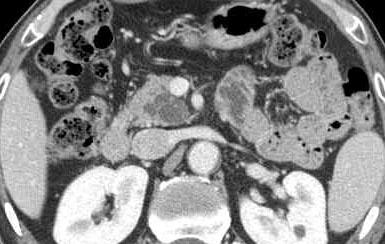 - Ho Gak Kim. Differential diagnosis of cystic diseases of pancreas - A B Figure 12. CT scan and magnetic resonance cholangiopancreatography of branch-type intraductal papillary mucinous neoplasm.