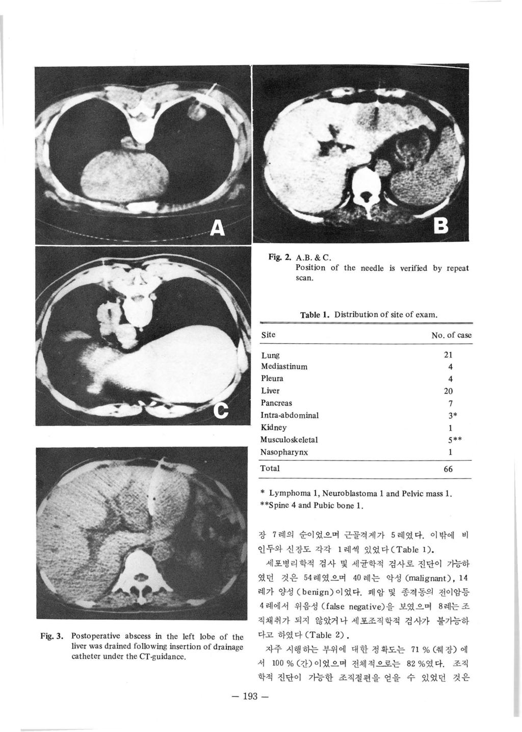 Fig.. A.B. & C. Position of the needle is verified by repeat scan. Table 1. Distribution of site of exam. Site No.