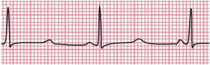 appearance LQT3 INa 5-10% 90% Long isoelectric segment with a normal symmetrical T wave 유전자이상의경우에서도불완전침투도와변이성의발현도 (variable expressivity) 를보이는것은복수의유전자결함과관련된다.