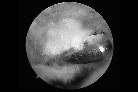 Unfallchirurg, 103: 462-467, 2000. 02)urkhart SS, rady PC: rthroscopic subscapularis repair: surgical tips and pearls to Z. rthroscopy, 22: 1014-1027, 2006.