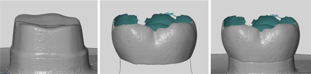 5. 변연및내면적합도측정및분석 Fig. 3. The constant seating force (40 N) was maintained using a universal testing machine for 5 minutes. 위에파우더 (Pure scan powder, Quest Corp.