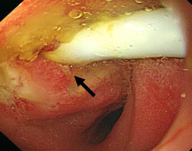Figure 1. Various endoscopic findings of ectopic openings; Most of the orifices (arrow) are slit-like shape on deformed duodenal bulb.