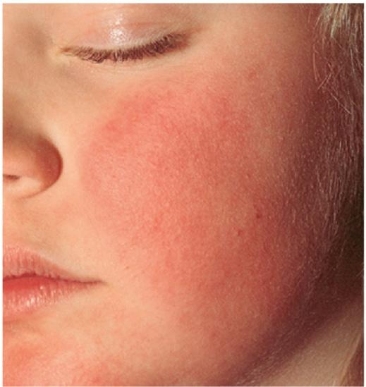 Erythema production 13 A result of dilation of the superficial blood cell caused by the release of histamine UVB exposure or UVA exposure after drug sensitization Mechanism of UV-induced erythema