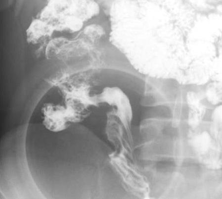 terminal ileum. (3.0%) 에서있었으며, 97% 의대부분의환자에서 2점이상의소장의적절한팽대를유도할수있었다. Crohn 병의급성기소견을횡단영상과관상영상에서나누어분석한결과는다음과같았다 (Table 3). 점막의과다조영증강은횡단영상에서 52예 (78.